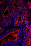 Genetisches Risikoprofil kann Darmkrebsvorsorge verbessern