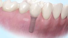 Patienten-Compliance ist das A und O: Periimplantitis vorbeugen und zielgerichtet behandeln