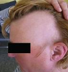 Haarausfall erzeugt Scham bei Patientinnen