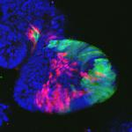 Mit Mini-Därmen funktionelle Unterschiede und Schwachstellen von Darmkrebs aufspüren