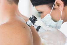 Sommer, Sonne, Hautkrebs: Neue Ansätze in der Immunonkologie treiben Forschung voran