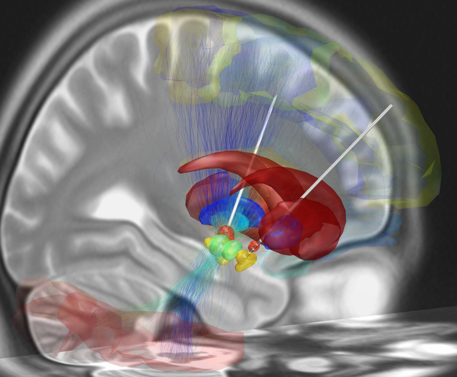 ein-jahr-nach-meiner-tiefen-hirnstimulation-parkinson-journal