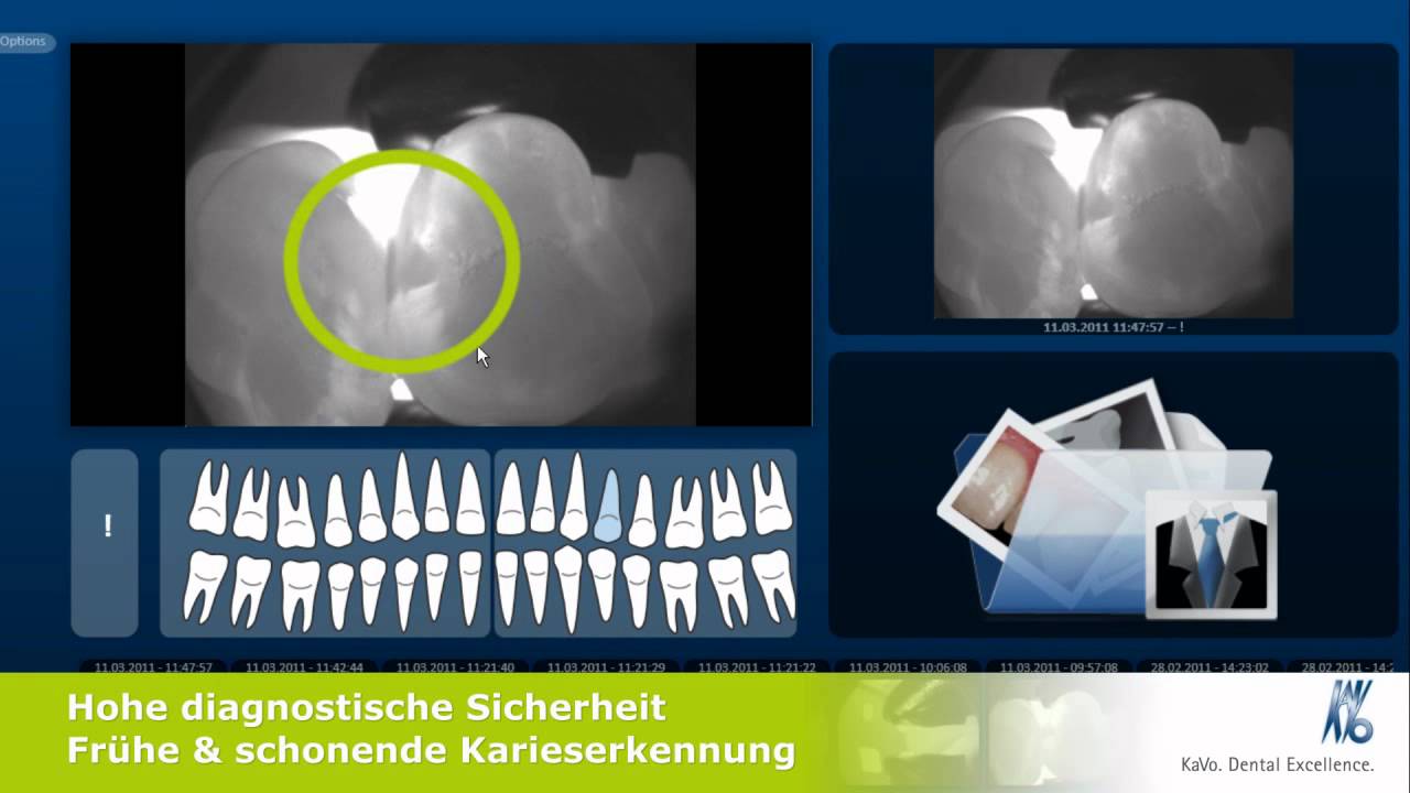 KaVo DIAGNOcam - Strahlungsfreie Kariesdiagnostik