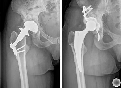 Bilder die deutlich machen wie kompliziert der Austausch defekter Hüftprothesen sein kann. Links ein verschlissenes Implantat: die Prothese hat sich gelockert und sitzt nicht mehr zentriert in der Gelenkpfanne. Rechts ein eingesetztes Zweitimplantat mit einem mittelkurzen Oberschenkelschaft und einer Abstützschale für das Becken. Foto: Asklepios Klinikum Bad Abbach