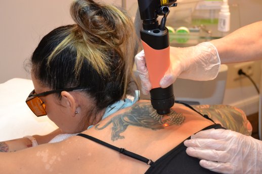 Tattooentfernung mit modernster Technik bei tattoolos HH.JPG