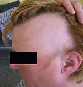 Beispiel Haarausfall