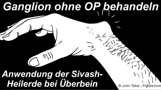 Ganglion (Überbein) Behandlung mit Sivash-Heilerde