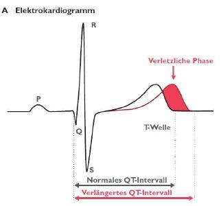 Während des Zeitabschnitts der Verlängerung des QT-Intervalls beim Long-QT-Syndrom besteht eine Phase erhöhter elektrischer Empfindlichkeit des Herzens