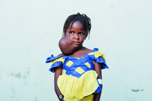 © Mercy Ships_Tumorpatientin Houleye aus dem Senegal vor der Operation.jpg