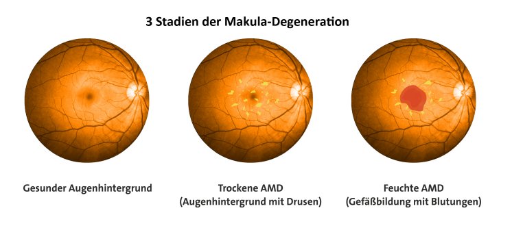 Abb_1_3_Stadien_der_Makula_Degneration.jpg