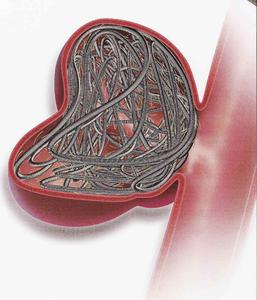 Gefahr der Hirnblutung gebannt: Platin-Spiralen im Aneurisma Foto: HELIOS Kliniken GmbH