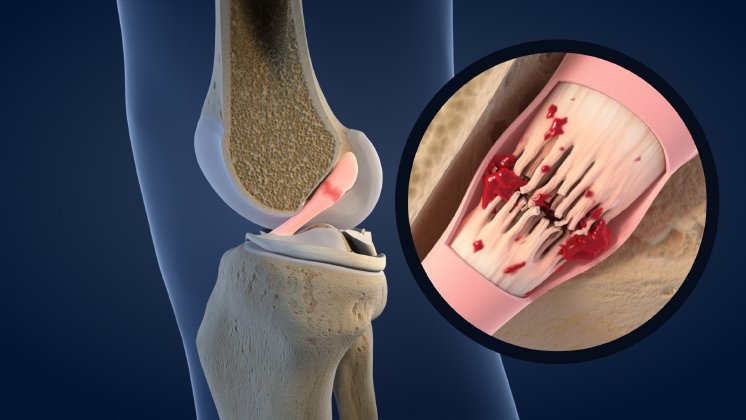 scoop   knee ACL synovial membrane  1542.jpg