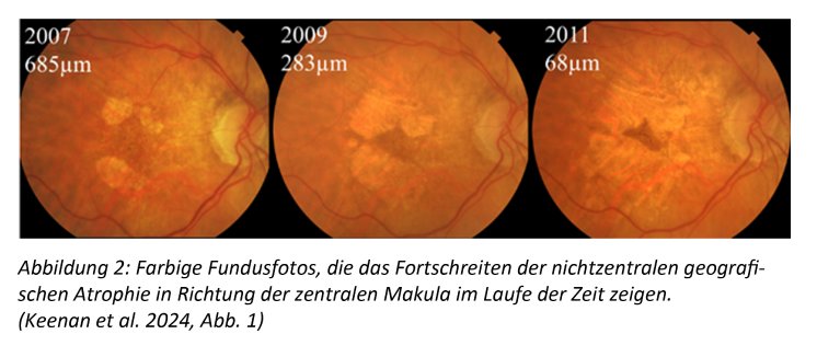 Abb. 2_Fortschreiten der nichtzentralen geografischen Atrophie.jpg