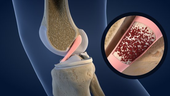 scoop   knee ACL synovial membrane  2317.jpg