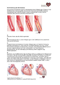 bildunterschrift-arteriosklerose-30-2016.pdf