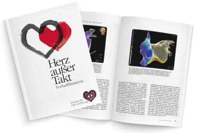 Vorhofflimmern: Operation steht an – wann Gerinnungshemmer wegen Blutungsrisiko absetzen?
