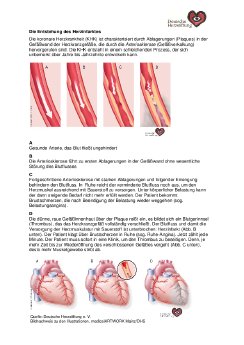 Fact Sheet Herzinfarkt Arteriosklerose.pdf