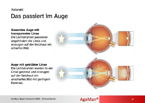 katarakt-grauer-star-erklaerung.jpg