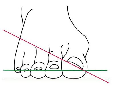 Warnzeichen für einen „Hallux valgus“: Der Nagel des großen Zehs dreht sich (rote Linie) aus der Idealposition (grüne Linie). Mit Fortschreiten der Erkrankung werden die anderen Zehen verdrängt