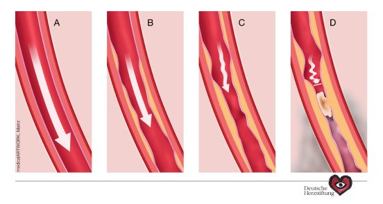 grafik-arteriosklerose.jpg