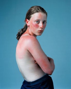 sunburnt-web.jpg