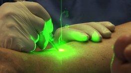Laserbehandlung