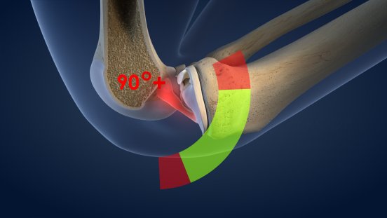 scoop   knee ACL synovial membrane  1780.jpg