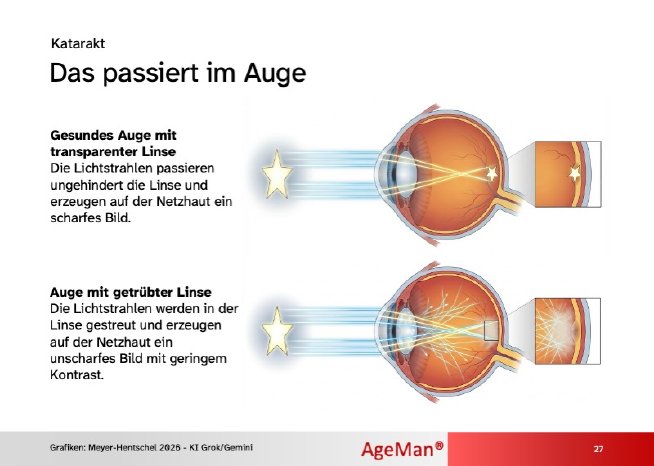 katarakt-grauer-star-erklaerung.jpg