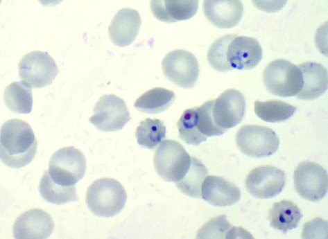 Malaria-Parasit Plasmodium falciparumring_1.jpg