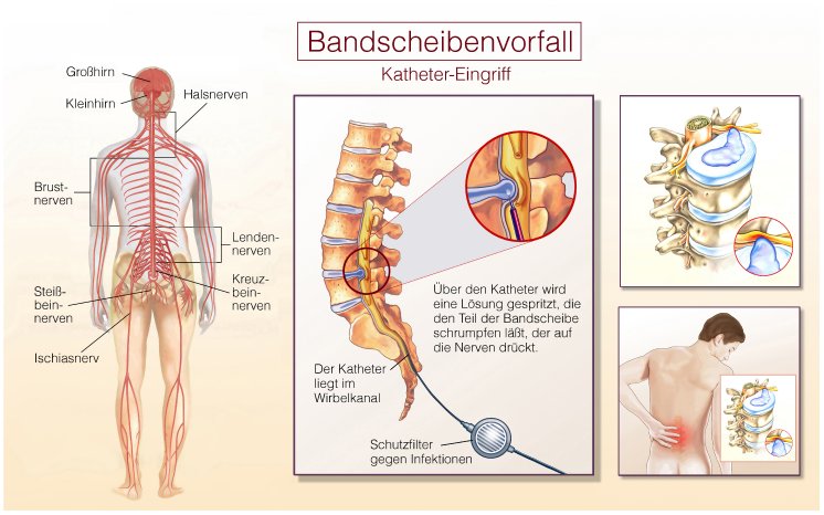 Den Urlaub ohne Rückenschmerzen genießen, Dr. Schneiderhan GmbH - MVZ  Praxisklinik Dr. Schneiderhan & Kollegen, Story - lifePR