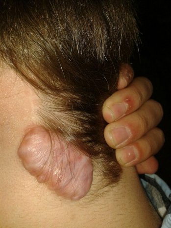 Keloid_Prof.Faulhaber_Vorher.jpg