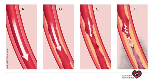 Arteriosklerose am Beispiel der Herzinfarkt-Entstehung. (c) medicalARTWORK Mainz/DHS / Quelle: Deutsche Herzstiftung