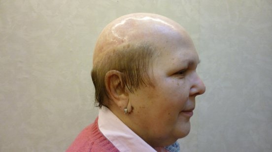 Seit ihrem 25. Lebensjahr leidet Hanne Fischer unter kreisrundem Haarausfall (www.superioni.jpg